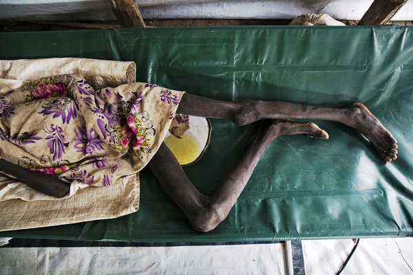 AFP__20170705__QB1OD__v8__HighRes__SsudanHealthCholera